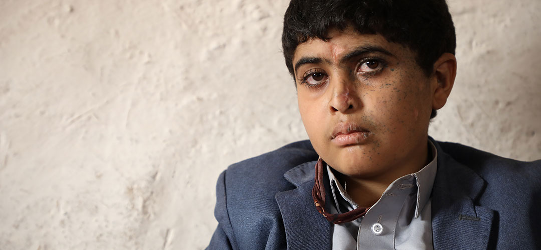 Ein verletzter Junge aus dem Jemen. Sein Gesicht weist Narben von einem Luftangriff auf, der seinen Schulbus traf. 