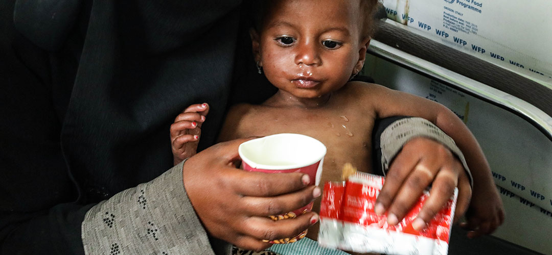 Ein mangelernaehrtes Kind im Jemen wird mit Notnahrung versorgt. 