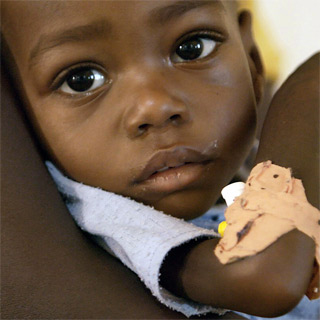 Die kleine Kadidja aus dem Niger ist akut mangelernährt